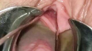 Extreme BDSM Female Urethral Stretching Medical Fetish Speculum Peehole Play